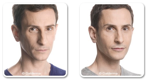 Facial rejuvenation in Dubai for men - Before After | The Champs-Elysées Clinic