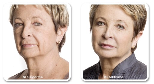 Facial rejuvenation for middle-aged women, before after | The Champs-Elysées Clinic