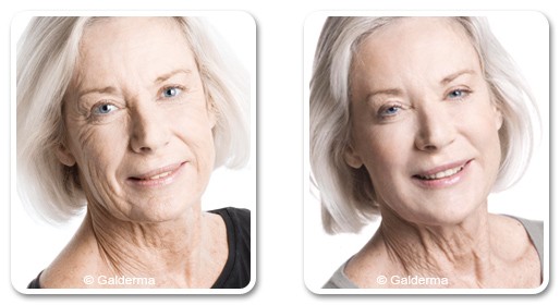 Face rejuvenation for mature skins in Dubai- before after | The Champs-Elysées Clinic