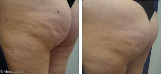 Cellulite Treatment with Accent Prime in Dubai | The Champs-Elysées Clinic