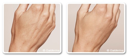 Hand Rejuvenation in Dubai - Before & After | The Champs-Elysées Clinic