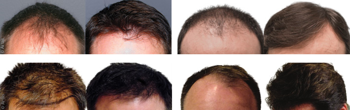 Hair transplant in Dubai with Artas - Before & After | The Champs-Elysées Clinic