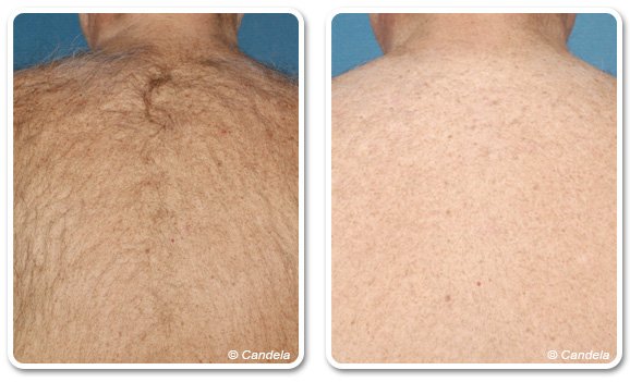 Men's laser back hair removal in Dubai | The Champs Elysées medical Clinic