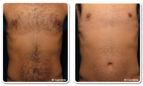 Belly and Chest Laser Hair Removal in Dubai | The Champs Elysées medical Clinic
