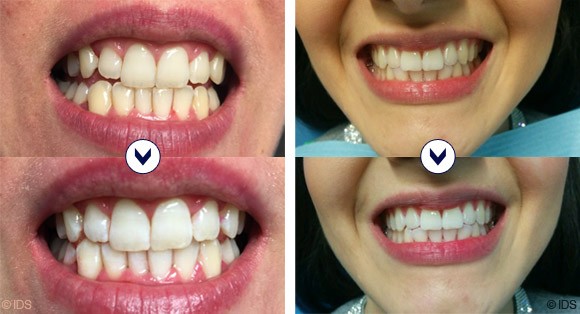Teeth whitening with BlancOne in Dubai | Champs Elysées medical Clinic