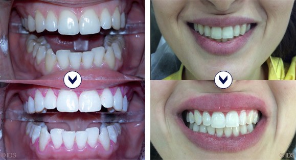 BlancOne: teeth whitening using photoactivation in Dubai | The Champs-Elysées Clinic