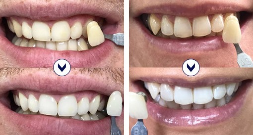 Teeth whitening with retainers in Dubai - Before & After | The Champs Elysées Clinic