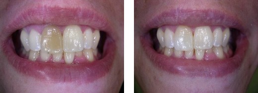 Internal teeth bleaching in Dubai | The Champs Elysées medical Clinic