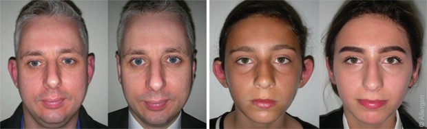 EarFold ear implants in Dubai - before after results | The Champs Elysées Clinic