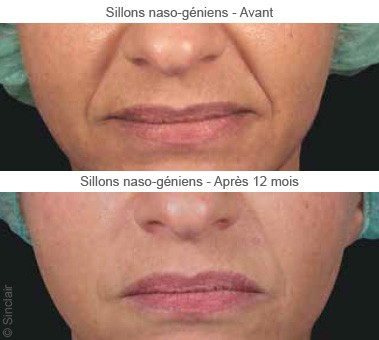 Nasolabial fold treatment in Dubai, Before & After | The Champs-Elysées Clinic