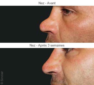 Rhinoplasty in Dubai -  Nose bridge reshaping | The Champs-Elysées Clinic