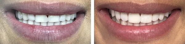 Dental Veneers in Dubai - Before & After Picture | The Champs-Elysées Clinic