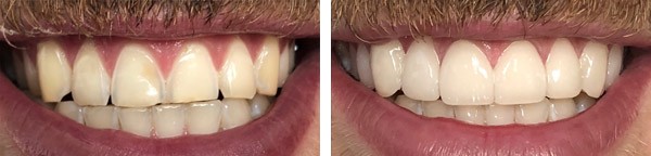 Ceramic veneers - Before & after picture | The Champs-Elysées Clinic