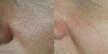 Large Pores Treatment in Dubai - before after | The Champs-Elysées Clinic