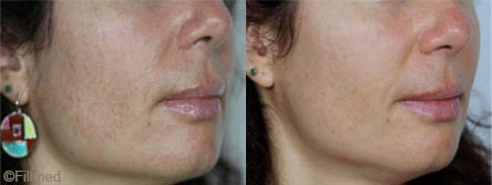 Hyperpigmentation treatment in Dubai - Before & After | The Champs-Elysées Clinic