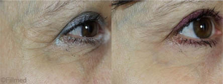 Fine lines and wrinkles treatment - before after | The Champs-Elysées Clinic