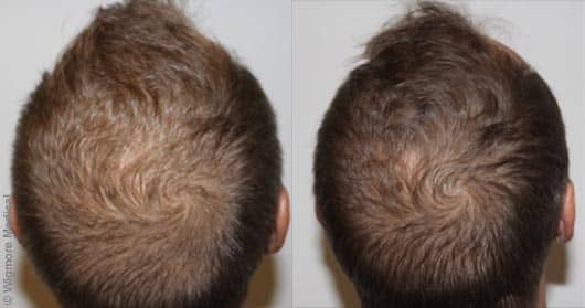 Scalp treatment in dubai | Before & After Picture | The Champs Elysées Clinic