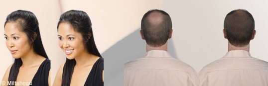 Hair Loss Treatment in Dubai - LED - Before After - The Champs Elysées medical Clinic