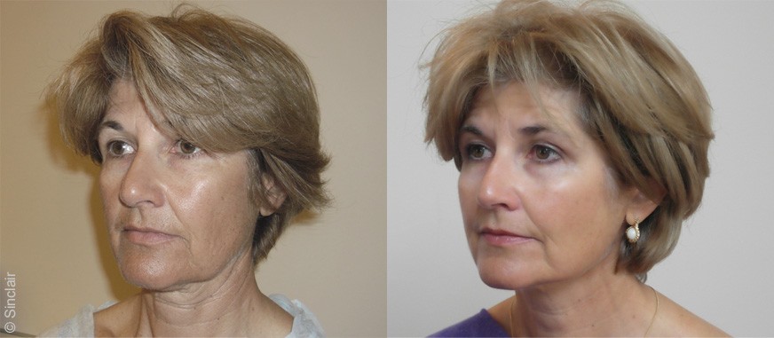 Skin Rejuvenation in Dubai - Women - Before & After | The Champs-Elysées Clinic