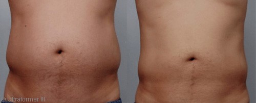Eliminating love handles with Ultraformer in Dubai - Before & after | The Champs-Elysées Clinic