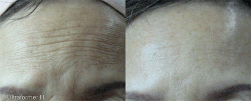 Forehead wrinkles removal in Dubai | before & after | The Champs-Elysées Clinic