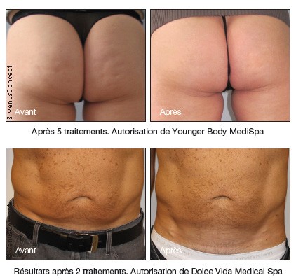 Body shaping with Venus Legacy in dubai - before after | The Champs-Elysées Clinic