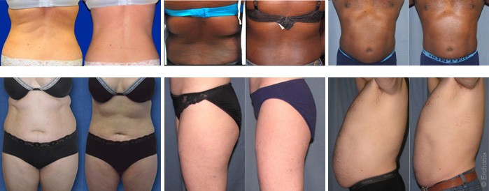Body shaping with Verju in dubai - before after | The Champs-Elysées Clinic