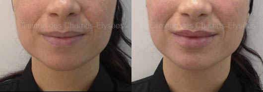 Hyaluronic Acid Lip Fillers in Dubai | before after | The Champs-Elysées Clinic