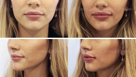 Lip Fillers in Dubai - Hyaluronic Acid - Before&After | The Champs-Elysées Clinic