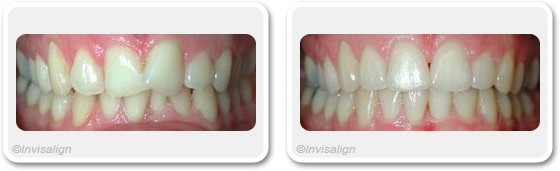 Overlapping teeth treatment in Dubai - before & after | The Champs-Elysées Clinic