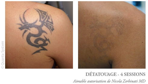 Nd:yag Pico Laser Treatment - Before & After | The Champs-Elysées Clinic