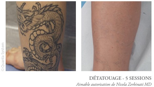 Laser tattoo removal with Discovery® Pico Plus in Dubai - The Champs-Elysées Clinic