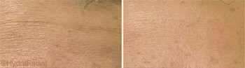 Forehead wrinkles treatment with HydraFacial in Dubai | The Champs Elysées Clinic