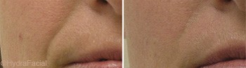 HydraFacial treatment for facial skin in Dubai | The Champs Elysées medical Clinic