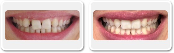 Invisalign in Dubai - Clear Aligners - Before & After | The Champs-Elysées Clinic