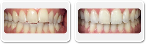 Invisible Braces for a perfect Smile in Dubai | The Champs-Elysées Clinic