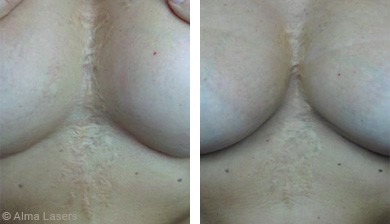 Scars treatment with Legato - Before & After | The Champs-Elysées Clinic
