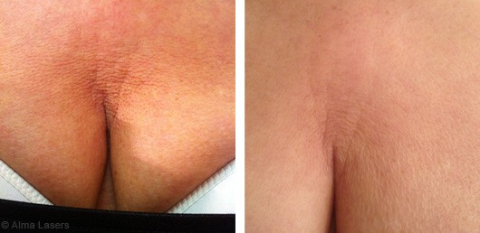 Cleavage wrinkles treatment, before after: The Champs-Elysées Clinic
