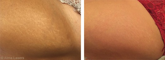 Stretch marks removal with Legato - Before & After | The Champs-Elysées Clinic