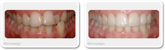 Cosmetic dentistry in Dubai - Before and After Pictures | The Champs-Elysées Clinic