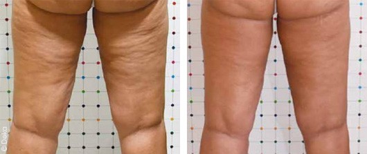 Cellulite Treatment Onda Coolwaves in Dubai - before after | The Champs-Elysées Clinic