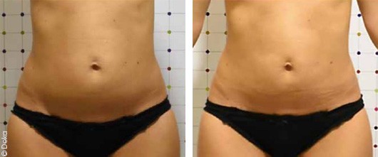 Reducing belly fat with Onda Coolwaves | Before & After | The Champs-Elysées Clinic