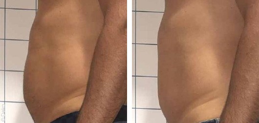 Abdominal fat treatment with Onda Coolwaves - before after | The Champs-Elysées Clinic