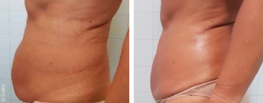 Saggy skin tightening with Onda Coolwaves in Dubai | Before & After Pictures