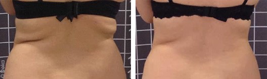 Back rolls treatment with Onda Coolwaves - before after | The Champs-Elysées Clinic
