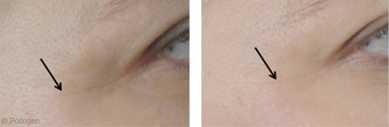 Under Eye Wrinkles Treatment in Dubai - Before & After | The Champs-Elysées Clinic