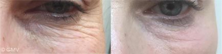 Under Eye Wrinkles Treatment in Dubai - Before & After | The Champs-Elysées Clinic