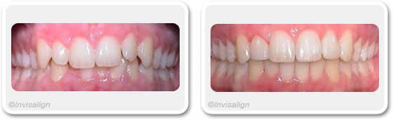 Dental Overbite Treatment in Dubai - before & after  | Champs-Elysées Clinic