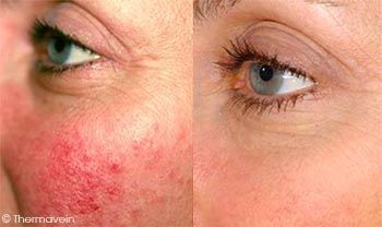 Rosacea Treatment in Dubai, Before & After | The Champs-Elysées Clinic