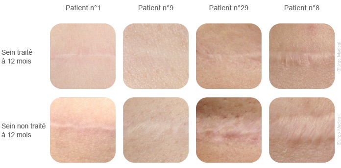 Scars removal in Dubai - Results with and without Urgotouch pictures